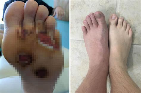 shock pics man reveals why you shouldn t go barefoot in