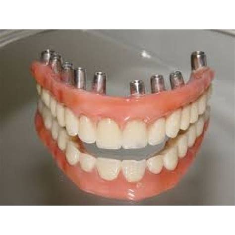 quanto custa um implante dentário consulta ideal