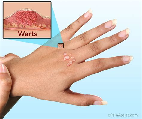 seed wart  finger  wart removal  treatment october      doctor