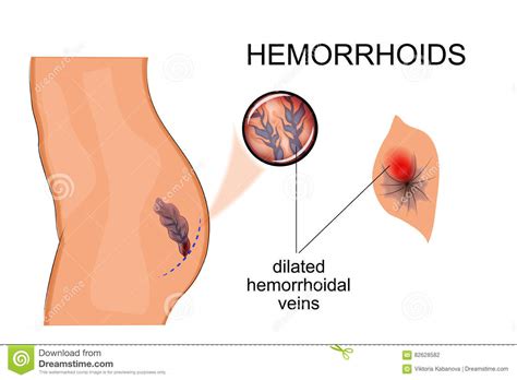 dilated veins hemorrhoids stock vector illustration of case 82628582