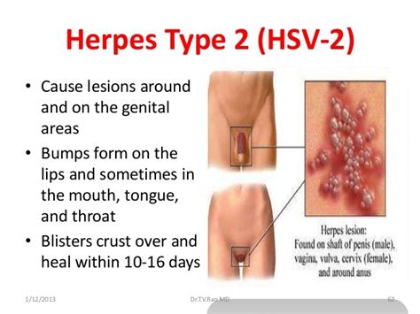 symptoms of genital herpes