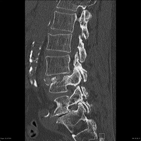 Xlif Subsidence Radiology Case