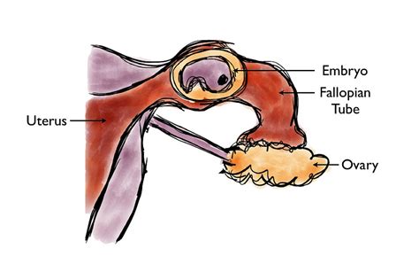 fileectopic pregnancy diagramjpg simple english wikipedia