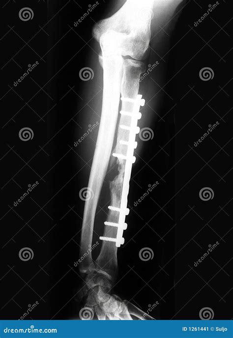 rayed forearm stock image image  negative bones