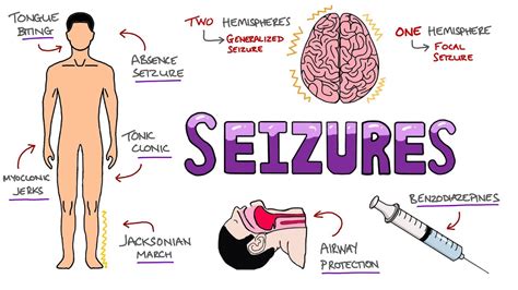 seizures seizure types generalized  focal seizures   seizures