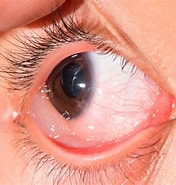 Image result for conjuntival. Size: 176 x 185. Source: www.clinicagonzalezcostea.es