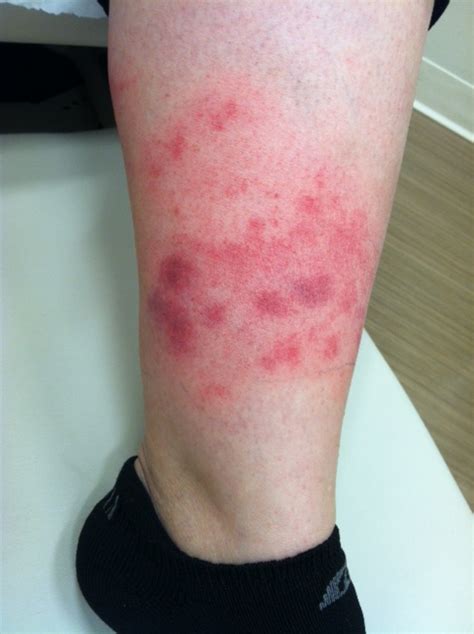 skin rash   leg pictures