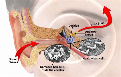 noise induced hearing loss  bend  practice