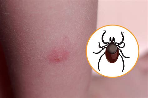 bug bites      identify page    factspedia