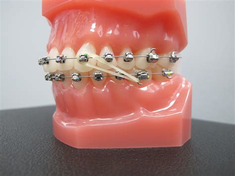 boschken orthodontics   dr boschken recommend wearing