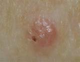 What Does Basal Cell Carcinoma Look Like Pictures