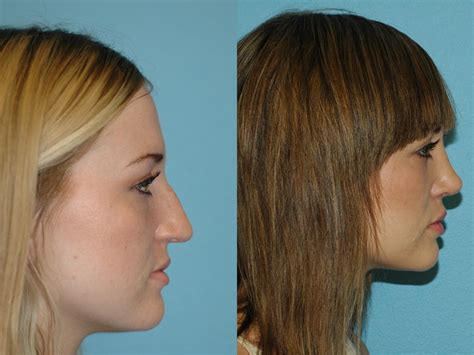 nose surgery    patient  san francisco ca