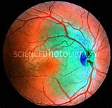 Eye Injury Blind Spot Pictures