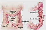 Photos of Pain With Acute Diverticulitis