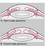 Chronic Open Angle Glaucoma Images