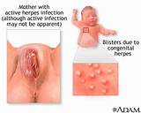 Photos of Herpes Zoster Diagnosis Blood Test