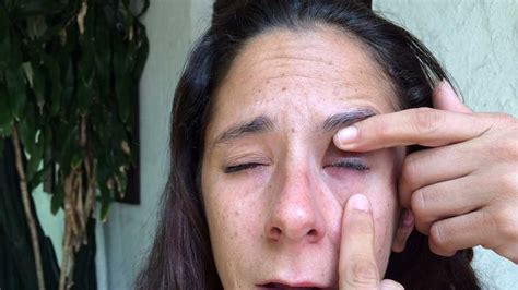 mixup leads to woman gluing eye shut