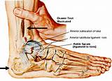 Ankle Injuries Pictures