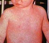 Images of Measles Diagnosis