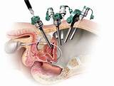 Images of Robotic Surgery For Prostate Cancer