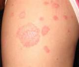 Autoimmune Disease Skin Rashes Images
