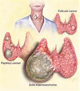 What Are The Symptoms Of Thyroid Cancer Images