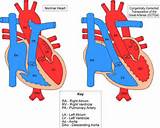 Congenitally Corrected Transposition Of The Great Arteries Photos