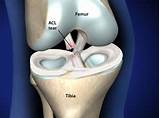 Images of Acl Injury