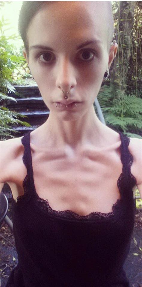 Woman Hid Food In Her Ears At Her Lowest Point With Anorexia Metro News