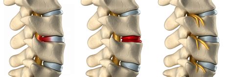 Herniated Discs Pinched Nerves And Bulging Discs
