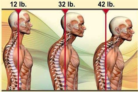 posture fix posture collar posture exercises bad posture poor