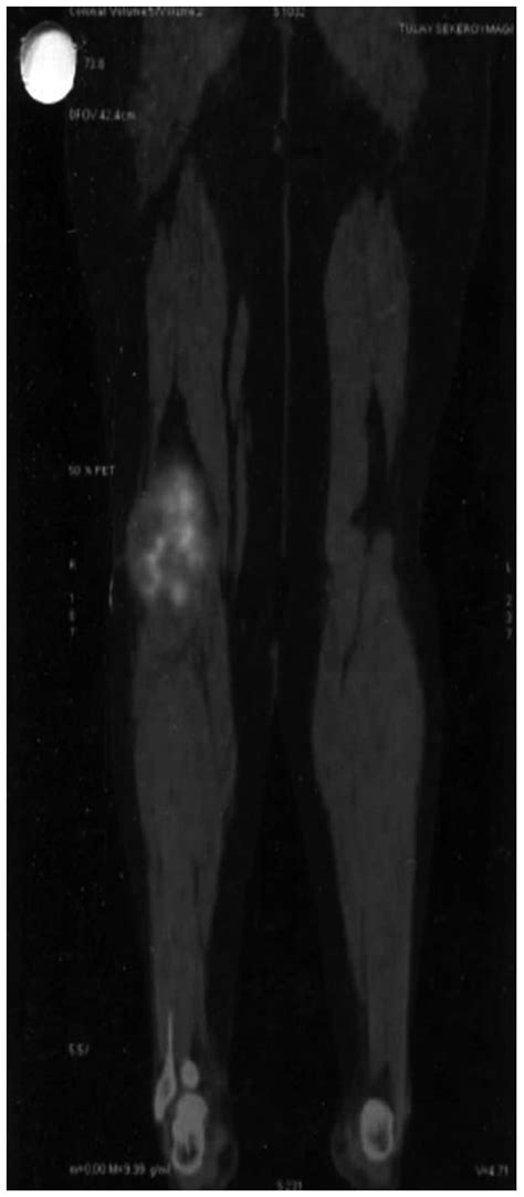 Targeted Treatment With Pazopanib In Metastatic Soft Tissue Sarcoma