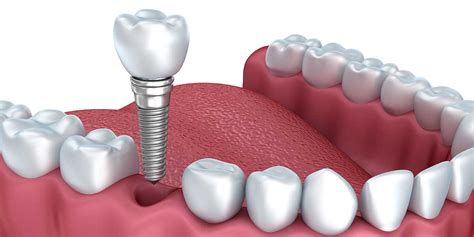 risks  dental implants