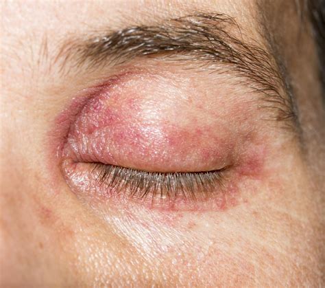 eyelid dermatitis treatment symptoms