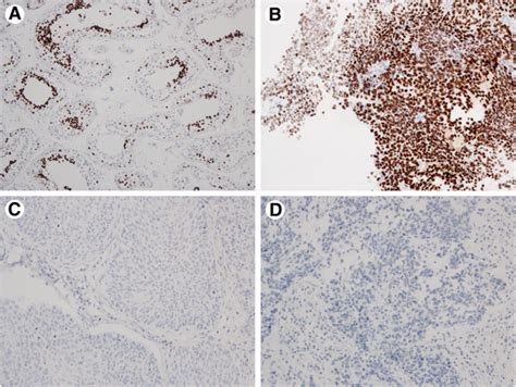 Nut Expression In Primary Lung Tumours Diagnostic Pathology Full Text