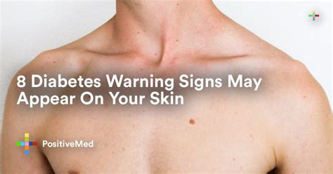 diabetes warning signs     skin