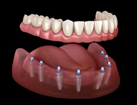 dental implants  turkey prices packages procedure