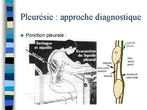 Syndrome Dpanchement Pleural Arique Et Liquidien Anatomie De