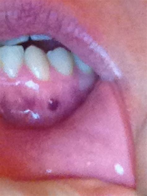just noticed black spot on back molar and have throbbing