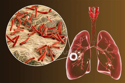 tuberculosis pulmonar fibrocavernosa  primer plano de la bacteria