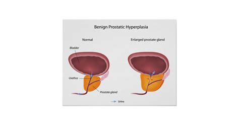 Benign Prostatic Hyperplasia Poster Zazzle