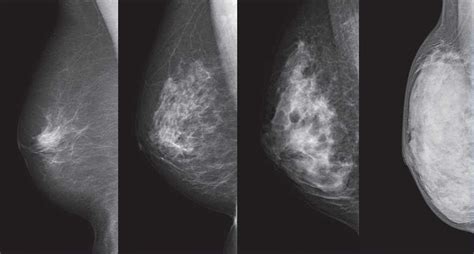 cancer and breast density what are doctors withholding the japan times