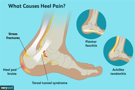 Heel Pain Causes Treatment And When To See A Doctor