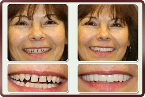 smile veneers  denticao odontologia odontologia estetica