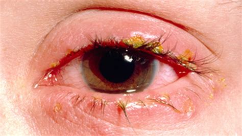 eye infections  baby children adults  diagnosis treatment