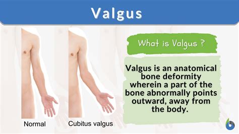 valgus definition  examples biology  dictionary
