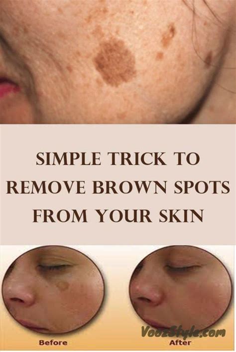 scary     brown spots    age