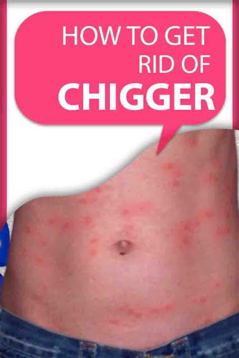 rid  chiggers   treat chigger bites