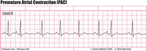 premature atrial contractions patmacrn