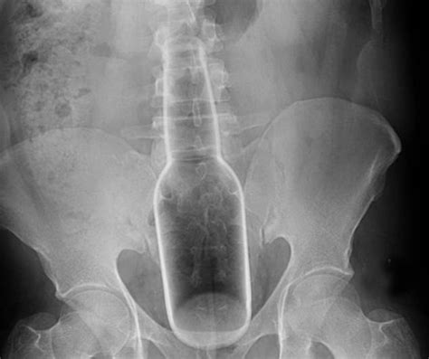 Very Unusual Objects Stuck Inside People’s Orifices That